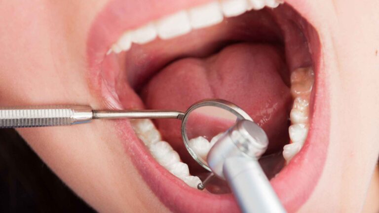 Root Canal Treatment