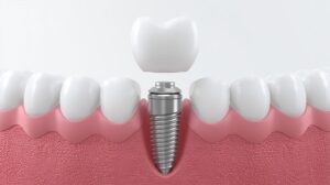 Long-lasting dental implants Hyderabad