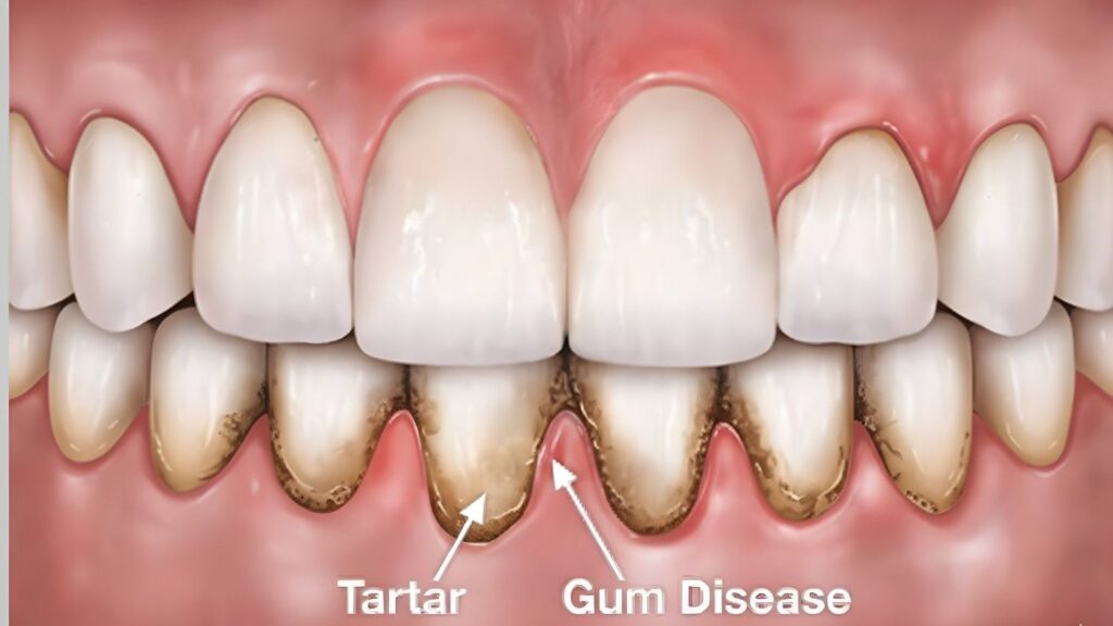 Periodontal Flap Surgery