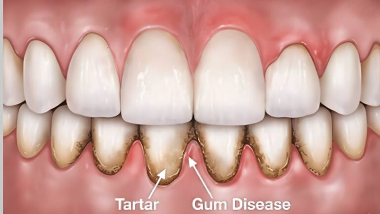 Periodontal Flap Surgery