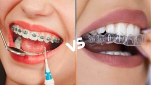 Braces vs Aligners