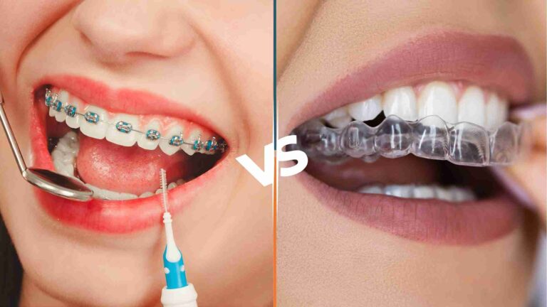Braces vs Aligners