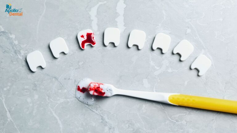 gums bleed treatment in nallakunta