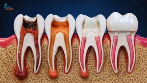 best root canal treatment in nallakunta Hyderabad