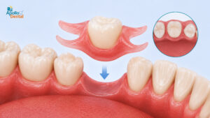 dental implants in nallakunta