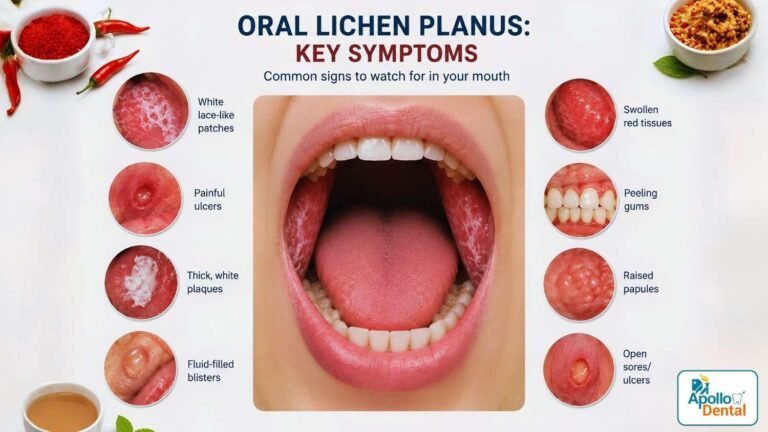 oral lichen planus in nallakunta